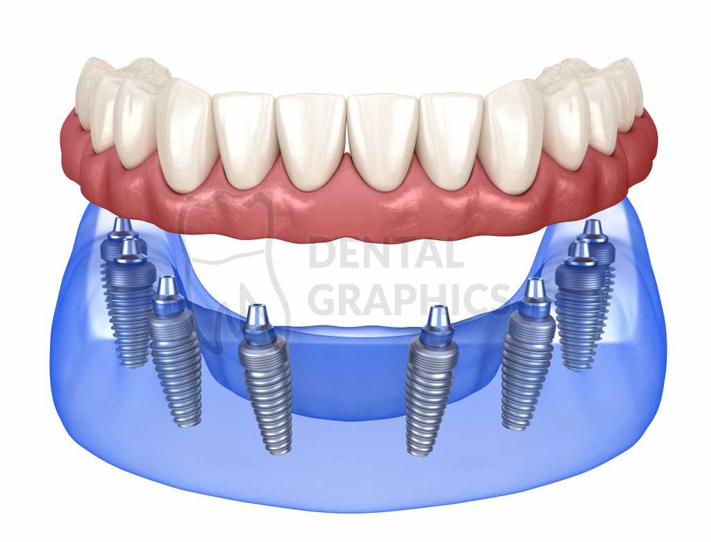 Имплантация зубов all on 6. Имплантация челюсти на 6 имплантах. Имплантация всей челюсти all on 4.